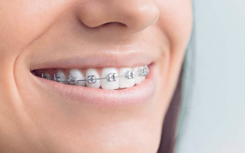 Adults braces