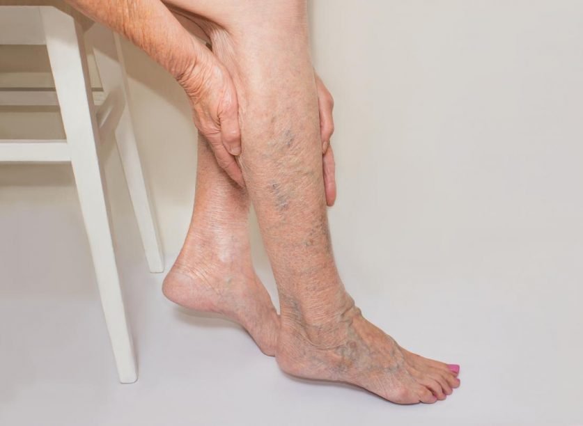 Varicose Veins