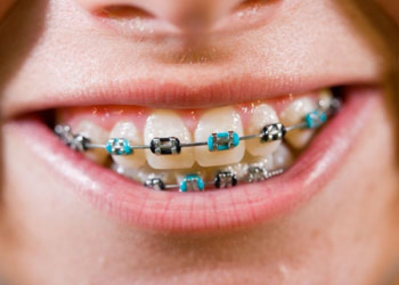 Braces color