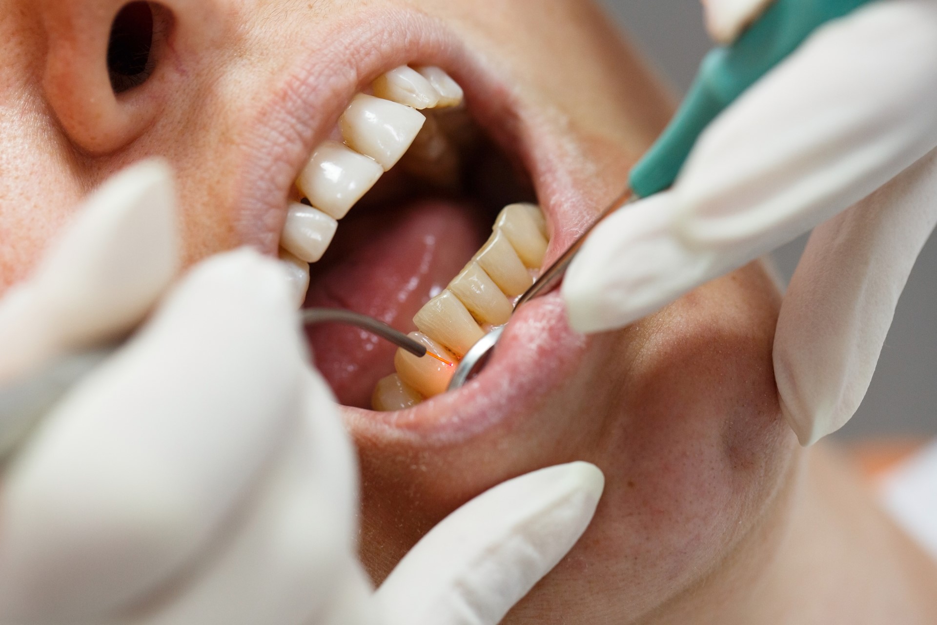 LANAP Dental Procedure