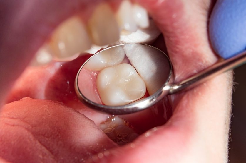 Dental Filling Treatment