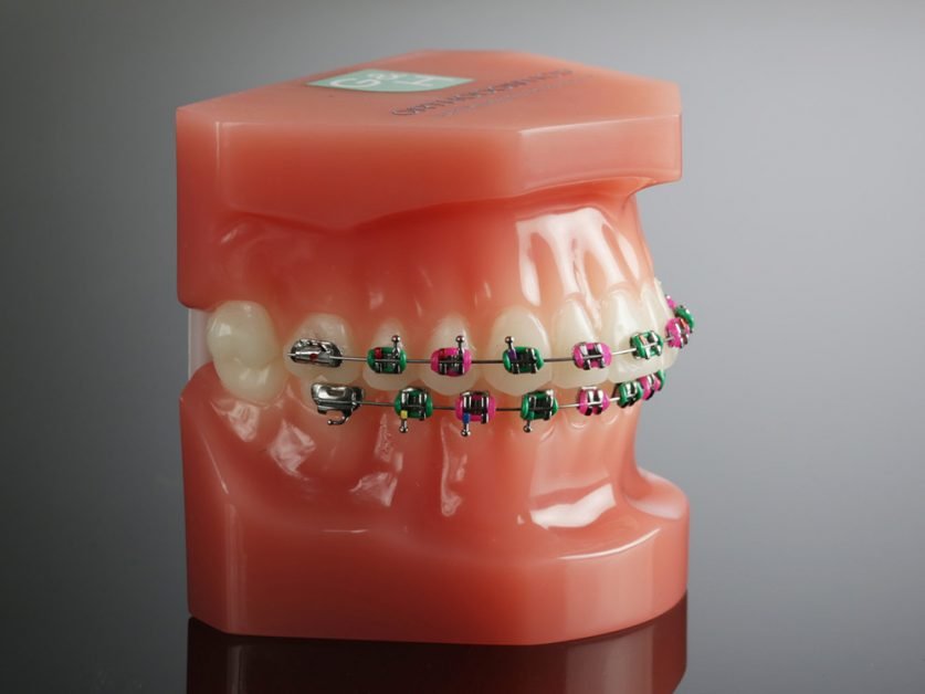 braces colors