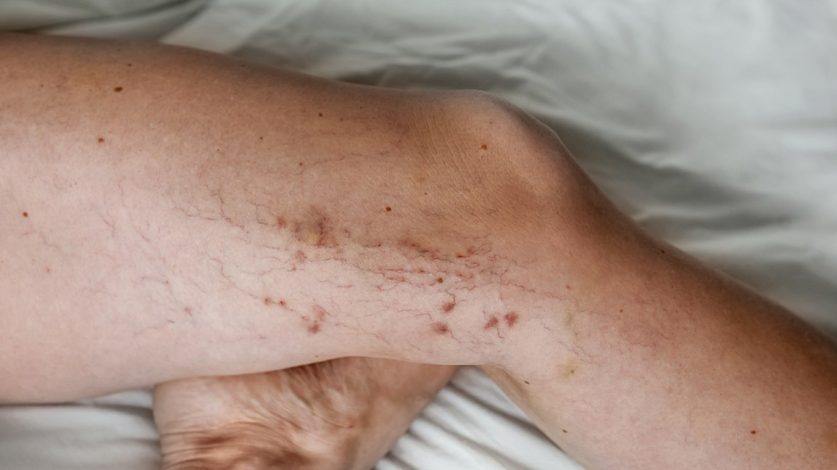 Varicose Veins Without Surgery