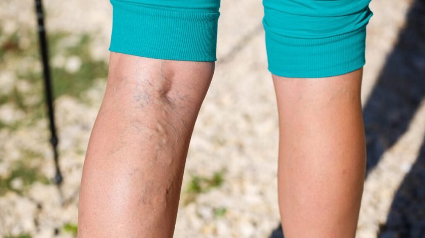 Varicose Veins Treatment