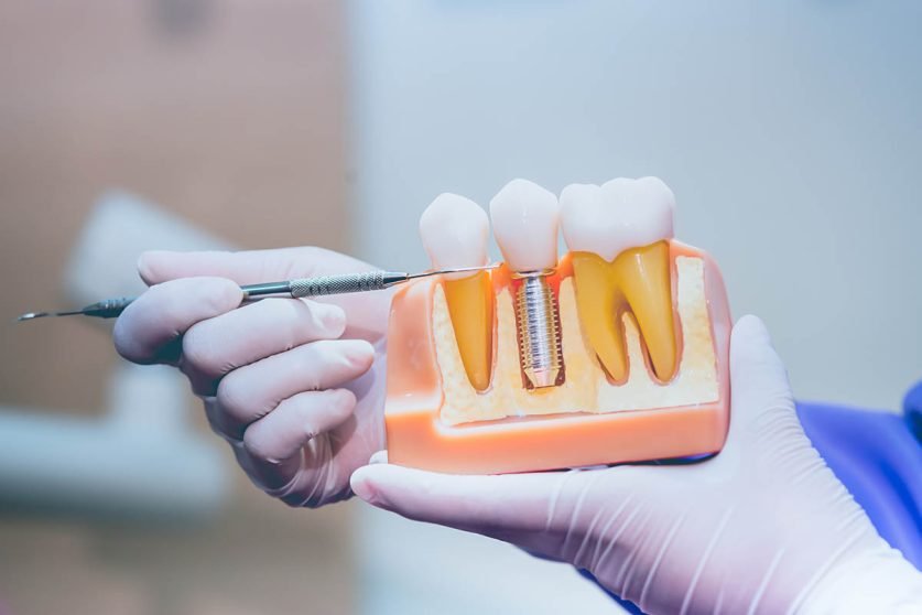 Dental Implants