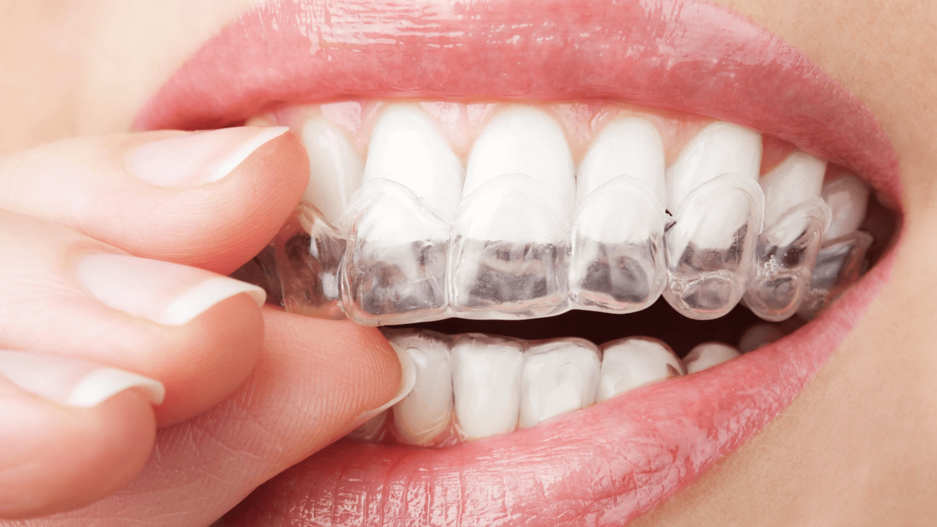 Invisalign north miami