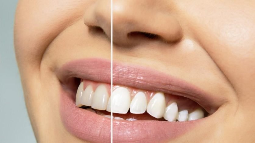 Laser Teeth Whitening