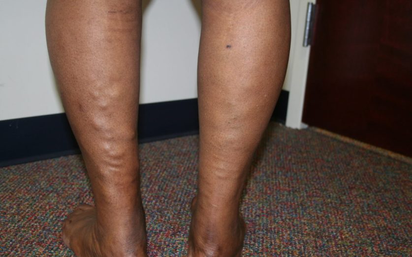 Leg Cramps From Varicose Veins