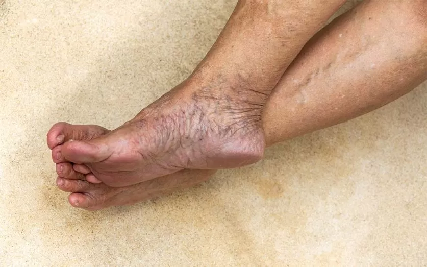 Varicose Vein Treatment