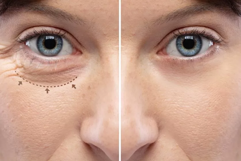Blepharoplasty